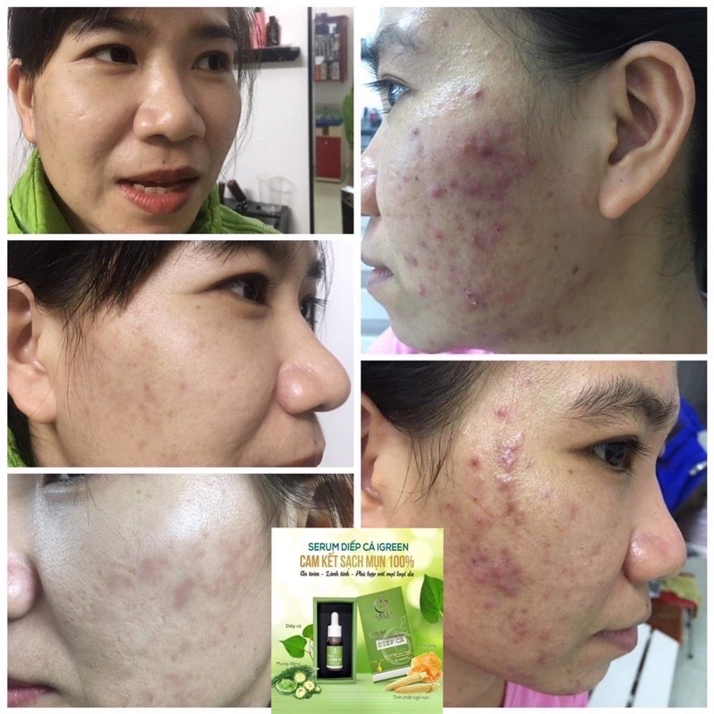 Sữa rửa mặt diếp cá Igreen sạch sâu, ngừa mụn chai 12ml